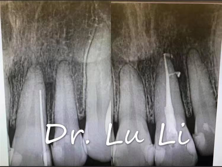 Root Canal Treatment (1)