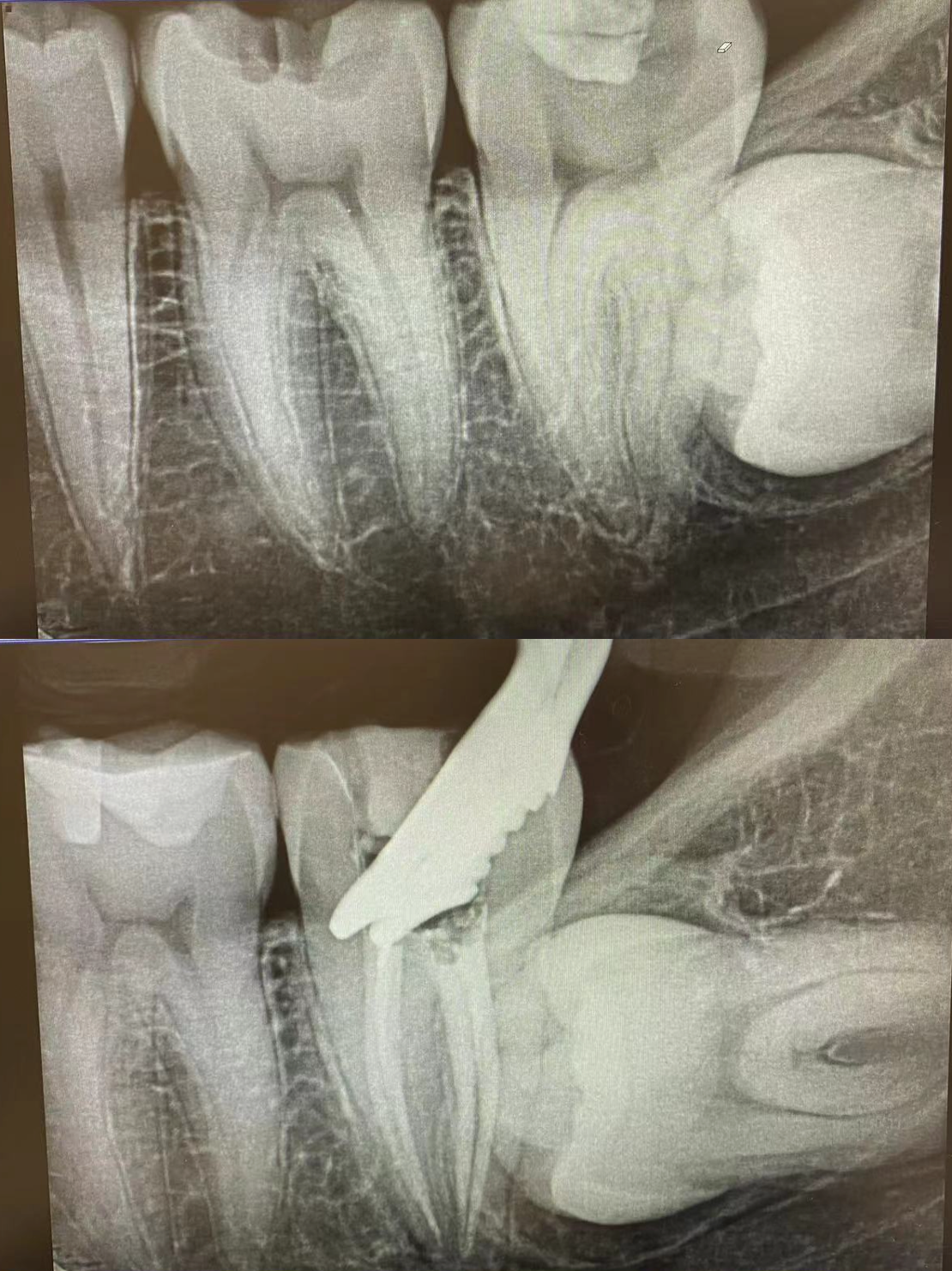 Root Canal Treatment (2)