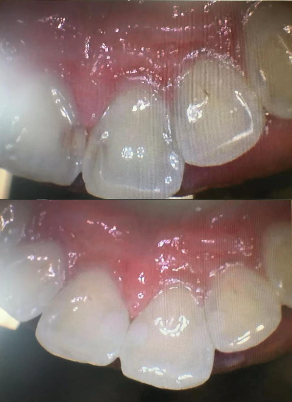 Composite Restoration (2)