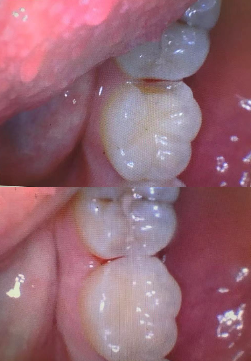 Functional Restoration