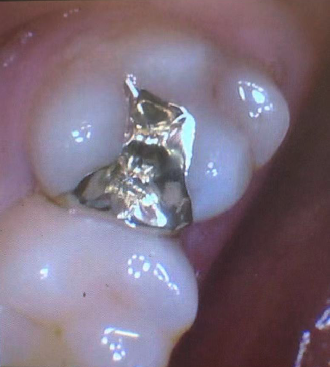 Gold Inlay