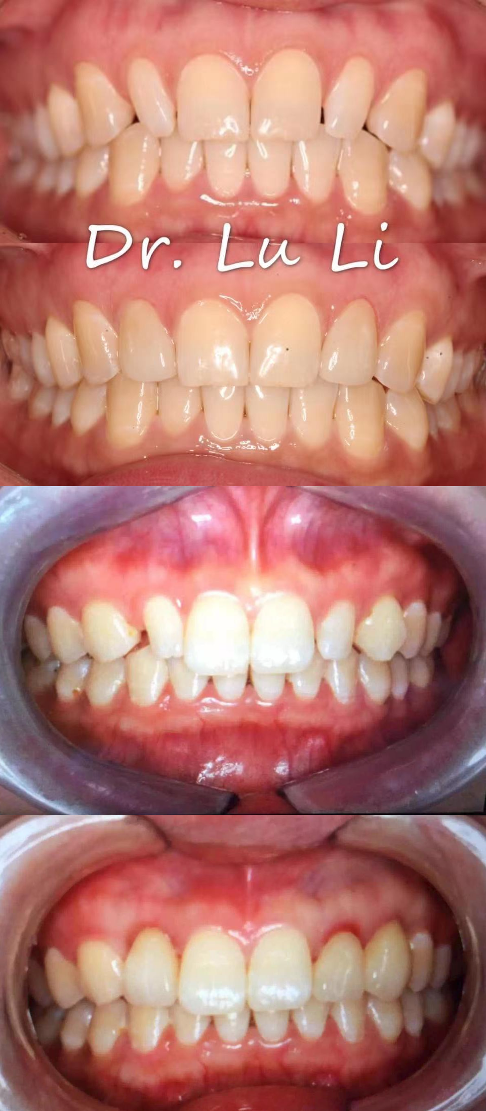 Esthetic Restoration
